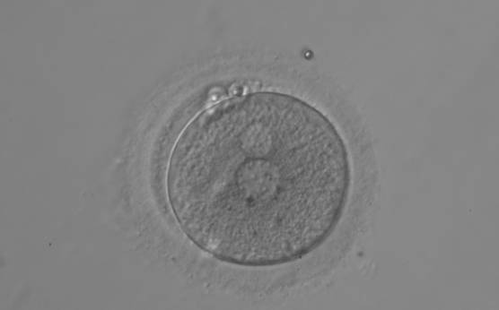 <p><strong>Figure 106</strong></p><p>A zygote displaying two polar bodies and unequal-sized juxtaposed PNs and inequality in number and alignment of small-sized NPBs (200× magnification).</p>