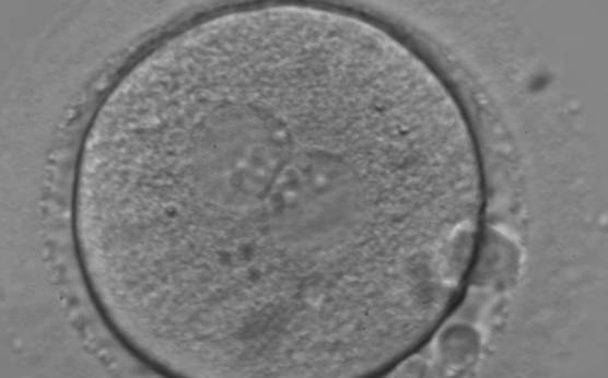 <p><strong>Figure 117</strong></p><p>An ICSI zygote with large-sized NPBs aligned at the PN junction (400× magnification). PNs are juxtaposed and centralized; polar bodies (the first polar body is fragmented, the second is intact) are located tangential to the longitudinal axis through the PNs.</p>