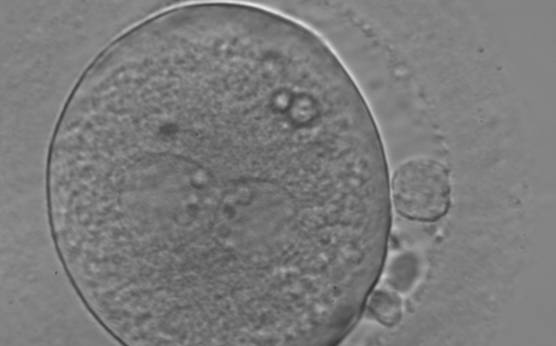 <p><strong>Figure 119</strong></p><p>An ICSI zygote with large-sized NPBs aligned at the PN junction (200× magnification). PNs, juxtaposed and centralized, are tangential to the plane through the polar bodies. It was transferred on Day 3 (seven cells) along with two other embryos but failed to implant.</p>