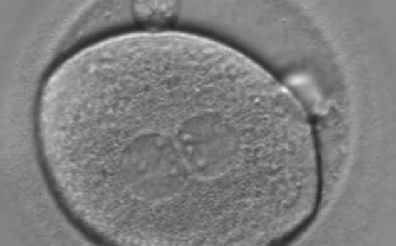 <p><strong>Figure 124</strong></p><p>A zygote of irregular shape observed 18 h post-ICSI (400× magnification). The visible PNs show unequal distribution of the NPBs. PNs are juxtaposed and centralized and the polar bodies form a great angle with respect to the longitudinal axis through the PNs. It was transferred but failed to implant.</p>