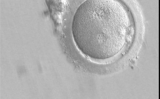 <p><strong>Figure 148</strong></p><p>A zygote which is entering syngamy and is displaying membrane breakdown particularly evident in the upper PN (400× magnification). The observation was performed 15 h after ICSI. One of the two PNs and its associated NPBs are now very indistinct. It was transferred but failed to implant.</p>