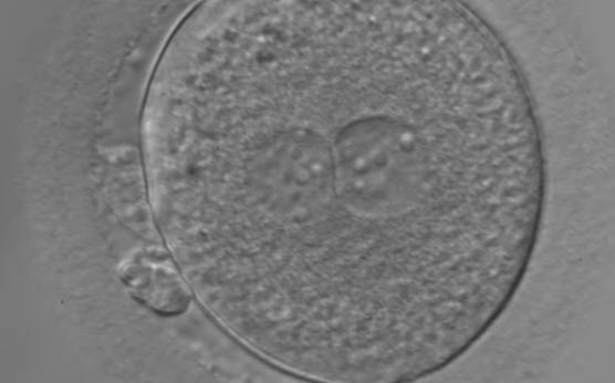 <p><strong>Figure 155</strong></p><p>An ICSI zygote with large-sized NPBs scattered with respect to the PN junction (400× magnification). The cytoplasm appears granular. It was transferred but failed to implant.</p>
