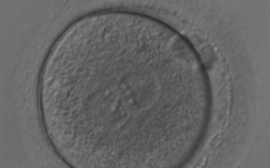 <p><strong>Figure 165</strong></p><p>A zygote generated by ICSI with equal numbers of large-sized NPBs aligned at the PN junction (200× magnification). It was transferred but the outcome is unknown.</p>