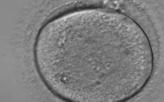 <p><strong>Figure 169</strong></p><p>A zygote generated by ICSI showing different numbers of NPBs (400× magnification). The cytoplasm appears granular. It was transferred but failed to implant.</p>