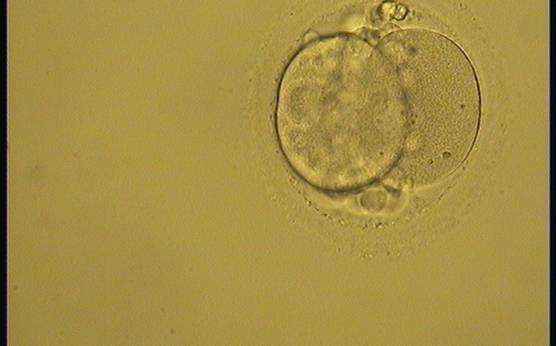 <p><strong>Figure 235</strong></p><p>A 2-cell embryo with 20–25% fragmentation on Day 2 (slow development). The blastomeres are evenly sized but binucleated. It was generated by ICSI but was not transferred.</p>