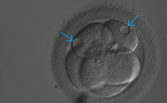 <p><strong>Figure 276</strong></p><p>A 5-cell embryo with two small and three large blastomeres. There is a small vacuole in each of the two smaller blastomeres.</p>