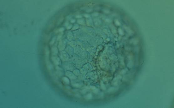 <p><strong>Figure 322</strong></p><p>Expanded blastocyst (Grade 4:1:1) with an ICM clearly visible at the 4 o′clock position in this view. There are very many evenly sized cells making up a cohesive TE that surround the enlarged blastocoel cavity. The ZP is very thin. The blastocyst was transferred but the outcome is unknown.</p>