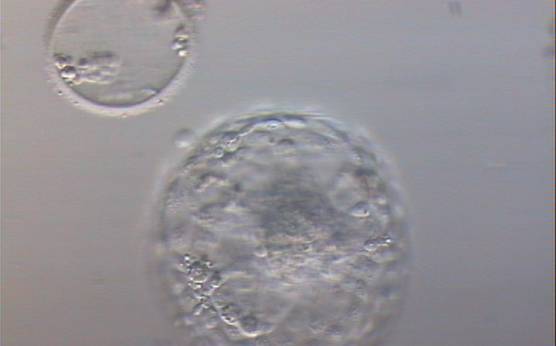<p><strong>Figure 336</strong></p><p>Hatched blastocyst (Grade 6:1:1) that is now completely free of the ZP which can be seen in the same view. Some cellular debris remains behind in the empty ZP. The ICM is large and compact at the base of the blastocyst and there are many TE cells making up a cohesive epithelium. In this view, it is possible to clearly see the increase in diameter of the blastocyst from the diameter of the original embryo which was accommodated within the ZP.</p>