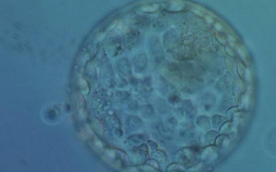 <p><strong>Figure 349</strong></p><p>Hatching blastocyst (Grade 5:2: 1) showing a compact ICM toward the 1 o′clock position in this view. The ICM is very small and made up of few cells relative to the size of the blastocyst. There are a few small, dark degenerative foci in the TE cells. The blastocyst was transferred but failed to implant.</p>