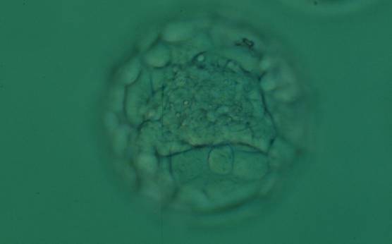 <p><strong>Figure 359</strong></p><p>Expanded blastocyst (Grade 4:1:1) with a large stellate ICM present at the base of the blastocyst in this view. The blastocyst was transferred and implanted.</p>