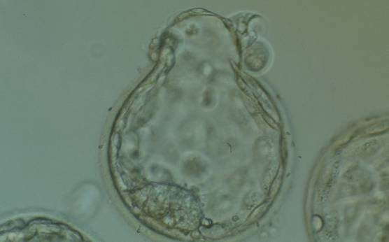 <p><strong>Figure 388</strong></p><p>Hatching blastocyst (Grade 5:1:1) in which a large, compact ICM can be seen at the 7 o'clock position and the herniating TE can be seen at the 12 o'clock position in this view. Several large fragments can be observed inside the blastocoel cavity. The blastocyst failed to implant after transfer.</p>