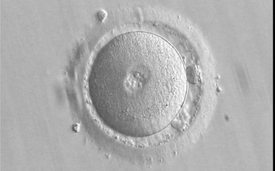 <p><strong>Figure 85</strong></p>

<p>A zygote 16.5 h post-ICSI, having small-sized PNs with scattered NPBs and two visible polar bodies (400× magnification). The zona pellucida (ZP) appears regular; some debris is present in the perivitelline space (PVS). The cytoplasm is homogeneous and displays a clear cortical zone. It was transferred resulting in a clinical pregnancy followed by miscarriage.</p>