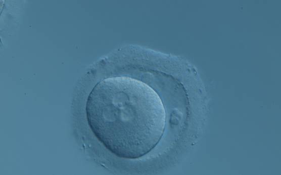 <p><strong>Figure 98</strong></p>

<p>A zygote displaying 3PNs after IVF with a small fragment adjacent to the PNs (200× magnification). There are two polar bodies in a large PVS and a thick ZP.</p>
