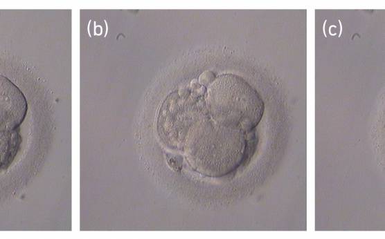 <p><strong>Figure 233</strong></p><p>Three views of the same embryo at different focal planes. It is a 4-cell embryo with 20–25% fragmentation which roughly corresponds to the size of one cell. Note the importance of assessing the embryo at different focal planes in order to establish the degree and type of fragmentation (scattered in this case). The blastomeres are evenly sized and have visible nuclei. It was generated by ICSI and cryopreserved.<strong><br></strong></p>