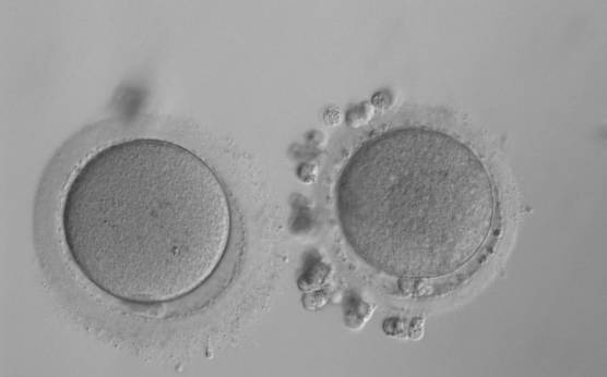 <p><strong>Figure 24</strong></p><p>Small MII oocyte (right) next to a normal-sized MII oocyte (left) from the same cohort (200× magnification).</p>