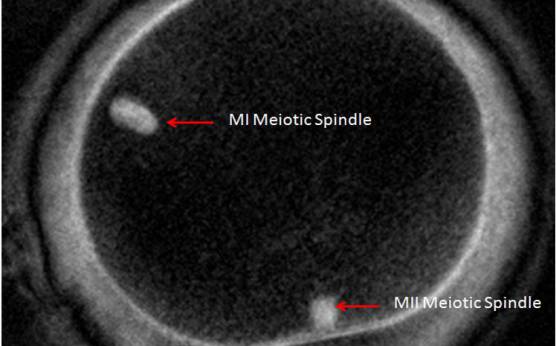 <p><strong>Figure 28</strong></p><p>Giant MII oocyte visualized at high power using polarized light microscopy. The two distinct MSs can be observed in the cytoplasm. One MS is from the MI (10 o'clock position) and the other is from MII (6 o'clock position; 400× magnification).</p>