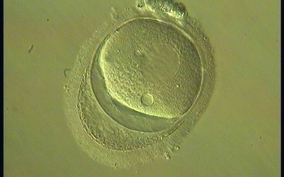 <p><strong>Figure 70</strong></p><p>Oocyte with an abnormally shaped ZP and with what appears to be a duplication of, or tears in, the ZP. The oocyte is highly dysmorphic with no evident PB1 in the PVS.</p>