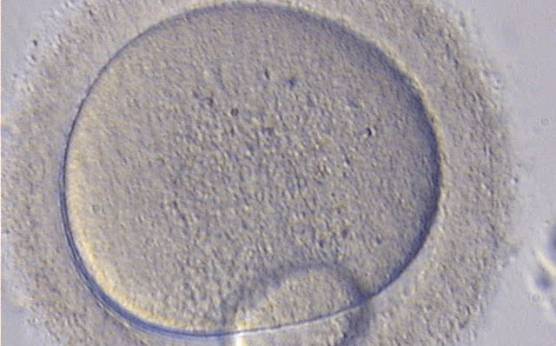 <p><strong>Figure 77</strong></p><p>MII oocyte with a giant PBI, 5-6 times larger than normal.</p>