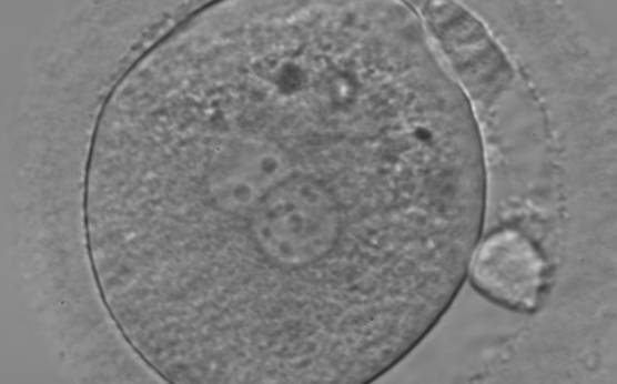 <p><strong>Figure 102</strong></p><p>A zygote generated by ICSI and observed 18 h post-insemination (400× magnification). PNs are slightly smaller than normal and exhibit inequality in the number and the distribution of NPBs. Polar bodies are larger than the normal size.</p>