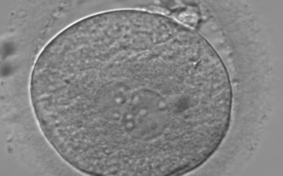 <p><strong>Figure 107</strong></p><p>A zygote observed 18 h post-insemination displaying very unequal-sized PNs and inequality in number and alignment of NPBs (400× magnification). It was transferred on Day 3 (seven cells) along with two other embryos. The implantation result is therefore unknown. However, the patient delivered a healthy baby boy.</p>