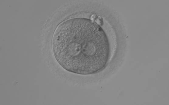 <p><strong>Figure 113</strong></p><p>An ICSI zygote with large-sized NPBs aligned at the PN junction (200× magnification). PNs are juxtaposed and centralized, fragmented polar bodies are located parallel to the longitudinal axis through the PNs (±30°).</p>