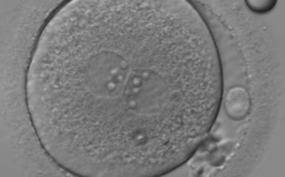 <p><strong>Figure 118</strong></p><p>An ICSI zygote with large-sized NPBs aligned at the PN junction (400× magnification). PNs are juxtaposed and centralized; polar bodies (the first polar body is fragmented, while the second is intact) are located tangential to the longitudinal axis through the PNs.</p>