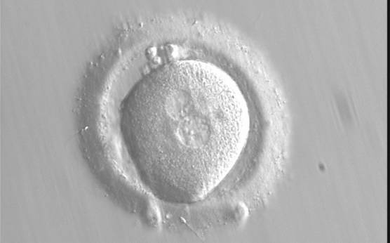 <p><strong>Figure 120</strong></p><p>Zygote observed at 16.5 h post-IVF displaying unequal-sized juxtaposed and centralized PNs aligned tangentially to the plane through the polar bodies (400× magnification). NPBs are scattered in one PN and aligned in the other. The oocyte is irregular in shape and the PVS is enlarged. It failed to implant following transfer.</p>