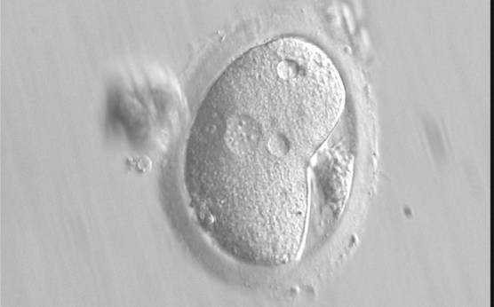 <p><strong>Figure 121</strong></p><p>A deformed zygote with peripheral PNs and polar bodies aligned tangentially to the plane through the polar bodies observed 15 h post-IVF (400× magnification). Polar bodies are highly dysmorphic. Note the presence of small vacuoles in the cytoplasm.</p>