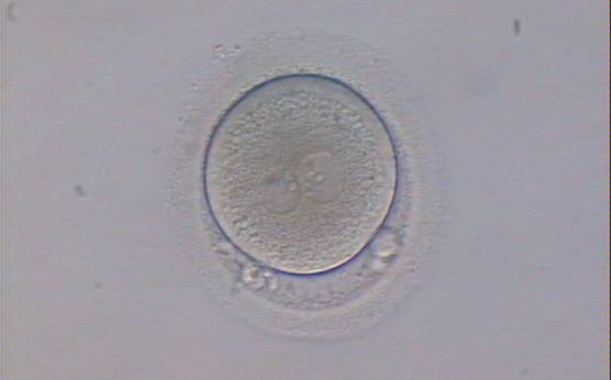 <p><strong>Figure 122</strong></p><p>An ICSI zygote displaying two PNs of approximately equal size, juxtaposed and clearly visible in the middle of the cytoplasm (400× magnification). Polar bodies are rotated >30° off the longitudinal axis through the PNs. A clear cortical area and coarse granularity of the cytoplasm can be observed. It was transferred but failed to implant.</p>