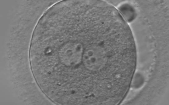 <p><strong>Figure 123</strong></p><p>Zygote observed 18 h post-ICSI, with inequality in number and alignment of the NPBs (400× magnification). PNs are juxtaposed and centralized, NPBs are aligned in one of the two PNs and scattered in the other with respect to the PN junction. Both polar bodies are rotated >30° off the longitudinal or meridional axis with a large degree of separation between them. It is possible to observe a clear cortical zone and some dark inclusion bodies. It was transferred and failed to implant.</p>