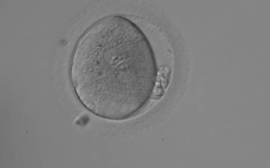 <p><strong>Figure 127</strong></p><p>Irregularly shaped zygote showing two centrally located and juxtaposed PNs with equal numbers of large-sized NPBs aligned at the PN junction (200× magnification). Fragmented polar bodies are located parallel to the longitudinal axis through the PNs (±30°). A clear cortical area and coarse granularity of the cytoplasm can be observed. It was transferred on Day 3 along with two other embryos and the patient delivered two healthy baby girls and one healthy baby boy.</p>