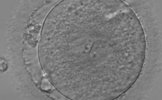 <p><strong>Figure 130</strong></p><p>A zygote with two centrally located and perfectly juxtaposed PNs in a slightly granular cytoplasm with a clear cortical zone (400× magnification). There is debris in the PVS as well as fragmentation of one polar body (presumably the first polar body), which is significantly separated from the other polar body (presumably the second polar body). It was transferred but the outcome is unknown.</p>
