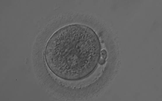 <p><strong>Figure 132</strong></p><p>A zygote 18 h post-ICSI displaying two PNs that are not juxtaposed (200× magnification). NPBs are of different size, aligned in one PN and scattered in the other. The cytoplasm is very granular.</p>