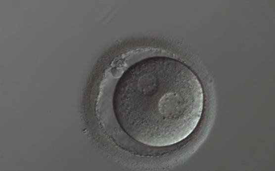 <p><strong>Figure 134</strong></p><p>A zygote with widely separated and unequal-sized PNs, which show scattered small NPBs (150× magnification). The cytoplasm appears slightly granular and the PVS is enlarged. It was transferred but implantation outcome is unknown.</p>