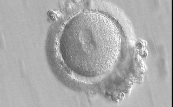 <p><strong>Figure 137</strong></p><p>A zygote displaying centrally located, and in this view, partially overlapping PNs (400× magnification). The PN longitudinal axis is parallel to the polar bodies. NPBs are scattered in both PNs with respect to the PN junction but differ in number. It was transferred and implanted.</p>