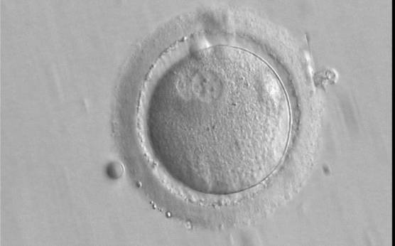<p><strong>Figure 144</strong></p><p>A zygote observed 16 h post-IVF showing peripheral PNs partly overlapping in this view (400× magnification). NPBs are small in size and scattered in both PNs. The derived embryo was highly fragmented with uneven blastomeres and was discarded.</p>