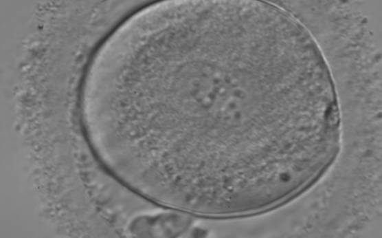 <p><strong>Figure 147</strong></p><p>A zygote entering syngamy observed at 18 h after ICSI (400× magnification). The PN membranes are becoming indistinct and have large-sized NPBs. The ZP appears ‘brush-like’ and there is a clear cortical region evident in the peripheral cytoplasm. Further development resulted in cleavage to 4 cell and arrest on Day 3.</p>