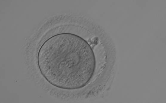 <p><strong>Figure 152</strong></p><p>A zygote observed 18 h post-ICSI with equal numbers of NPBs aligned at the PN junction (200× magnification). It shows a large PVS and an irregular ZP. The polar bodies are fragmented and overlapping in this view. It was transferred but the outcome is unknown.</p>