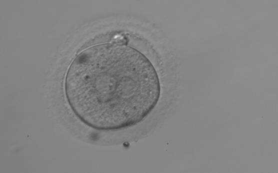 <p><strong>Figure 153</strong></p><p>A zygote observed 18 h post-ICSI with NPBs aligned at the PN junction (200× magnification). NPBs differ in number and size between PNs. The polar bodies are overlapped in this view. It was discarded due to subsequent abnormal cleavage.</p>
