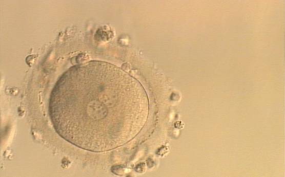 <p><strong>Figure 156</strong></p><p>An ICSI zygote with NPBs scattered with respect to the PN junction (400× magnification). Polar bodies are fragmented; there is debris in the PVS. It was transferred but implantation outcome is unknown.</p>