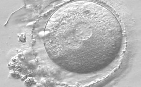<p><strong>Figure 162</strong></p><p>A zygote observed 16 h post-ICSI with small-sized NPBs scattered with respect to the PN junction in both PNs (400× magnification). It has a very thin ZP. It was transferred but failed to implant.</p>