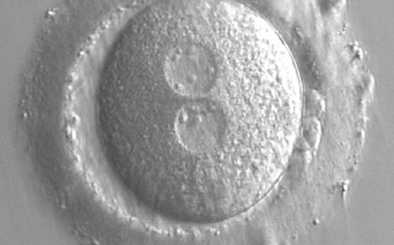 <p><strong>Figure 164</strong></p><p>A zygote at 15 h post-IVF in which NPBs are scattered in one of the two PNs and aligned in the other (400× magnification). The ZP is thick and the PVS is enlarged. One of the two polar bodies is fragmented. It was transferred and implanted.</p>