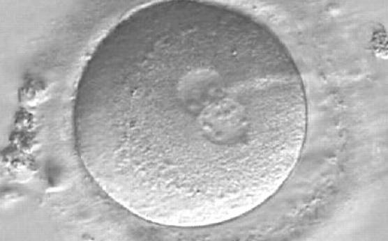 <p><strong>Figure 170</strong></p><p>A zygote observed 16.5 h post-ICSI, showing unequal number and size of NPBs: medium-sized and scattered in one PN, larger-sized and aligned in the other (400× magnification). Polar bodies had been biopsied, and the slit opened mechanically in the ZP is evident at the 3 o'clock position. It was cryopreserved.</p>