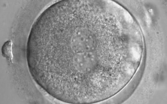 <p><strong>Figure 172</strong></p><p>A zygote generated by ICSI with a different number and size of scattered NPBs (600× magnification). It was discarded because of subsequent abnormal development.</p>