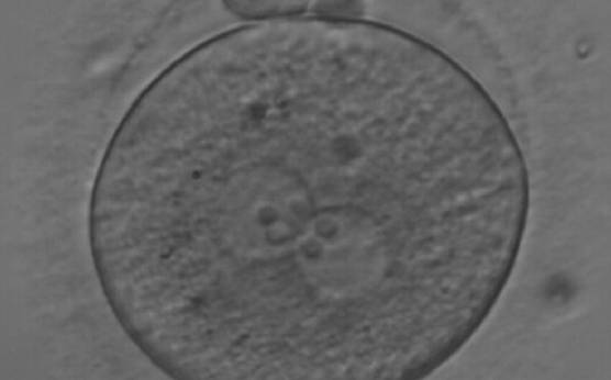 <p><strong>Figure 175</strong></p><p>A zygote observed at 18 h after ICSI, with NPBs of equal size in both PNs and aligned at the PN junction (200× magnification). Polar bodies are intact and slightly larger than normal. The cytoplasm is granular with some inclusions. It was discarded due to subsequent abnormal development.</p>
