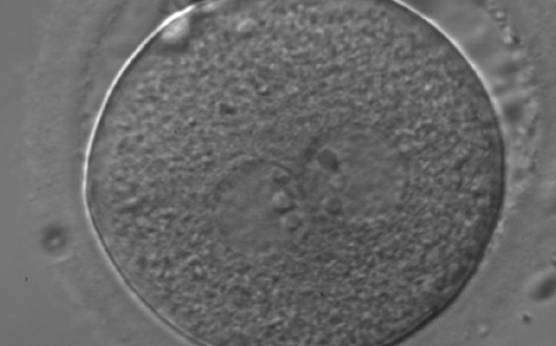 <p><strong>Figure 176</strong></p><p>A zygote generated by ICSI showing equal number and size of NPBs, which are perfectly aligned at the PN junction (200× magnification). Polar bodies are highly fragmented. It was transferred but clinical outcome is unknown.</p>