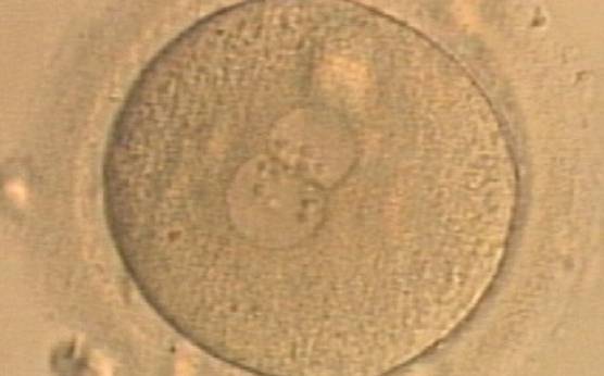 <p><strong>Figure 177</strong></p><p>A zygote generated by ICSI displaying unequal number and size of NPBs between the PNs (400× magnification). It was transferred but clinical outcome is unknown.</p>