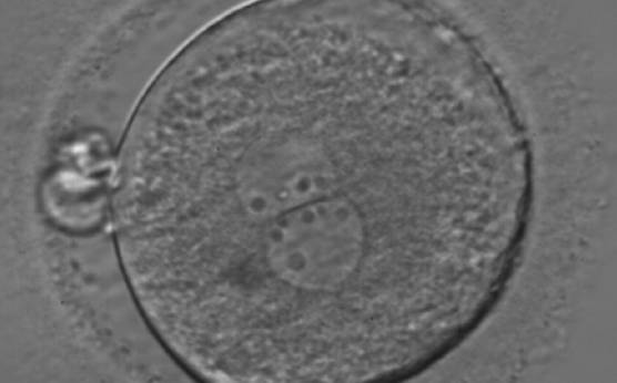 <p><strong>Figure 178</strong></p><p>A zygote generated by ICSI showing an unequal number of NPBs (400× magnification). The NPBs differ in size within each PN. It was transferred but clinical outcome is unknown.</p>