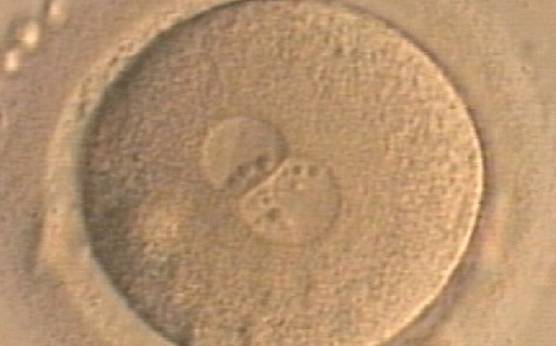 <p><strong>Figure 179</strong></p><p>A zygote generated by ICSI displaying unequal number and size of NPBs between the PNs (400× magnification). NPBs are mainly aligned at the PN junction. It was transferred but clinical outcome is unknown.</p>