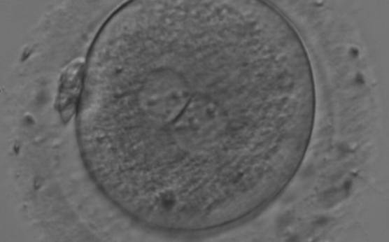 <p><strong>Figure 180</strong></p><p>A zygote generated by IVF with large NPBs scattered with respect to the PN junction (200× magnification). NPBs display differences in sizes within each PN and are slightly larger in the PN on the right side. It was transferred and resulted in a singleton pregnancy with delivery.</p>